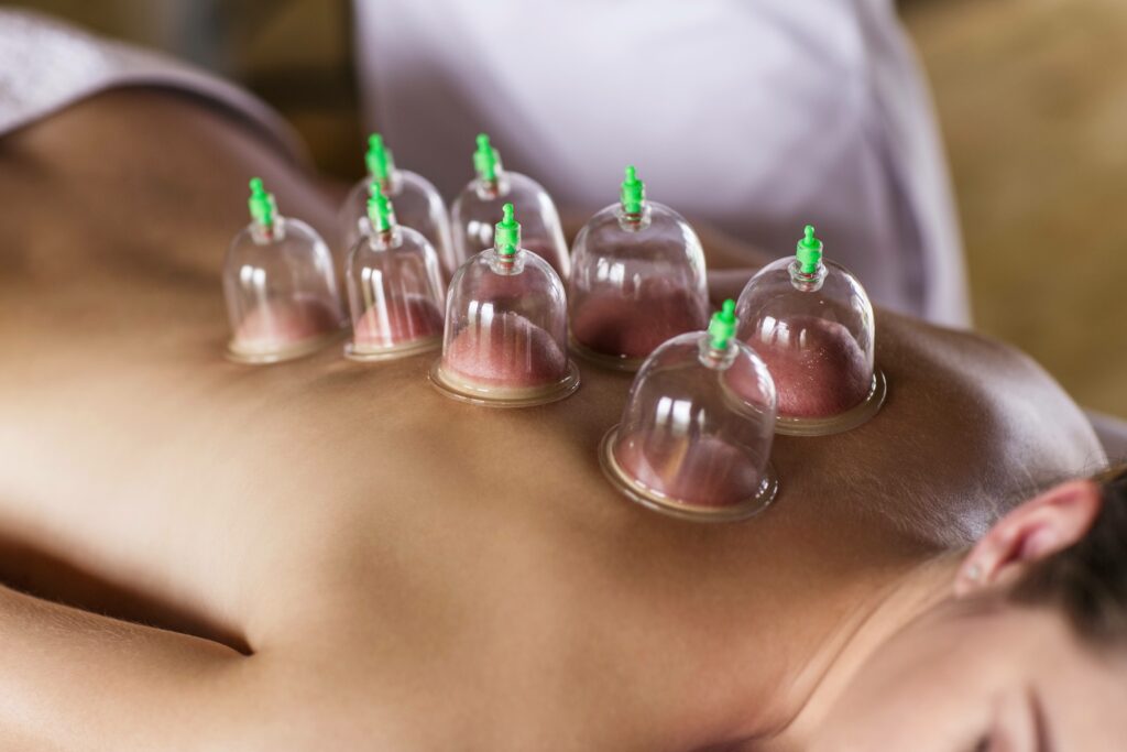 Maasage Tuina avec pose de ventouse sur le dos d'une cliente. Le cupping prolonge l'effet de décontraction et a une action drainante.